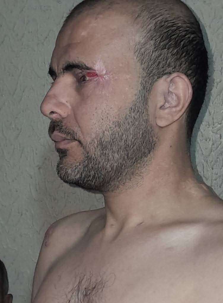 Image in @xIsraelExposedx's post: Palestinian hostages Mohammed Abu Tawila was released and enduring extreme torture in Israeli priso…