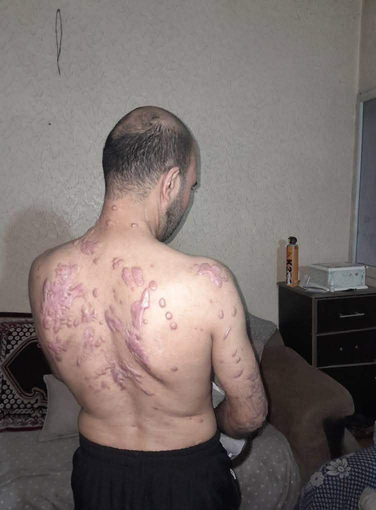 Image in @xIsraelExposedx's post: Palestinian hostages Mohammed Abu Tawila was released and enduring extreme torture in Israeli priso…