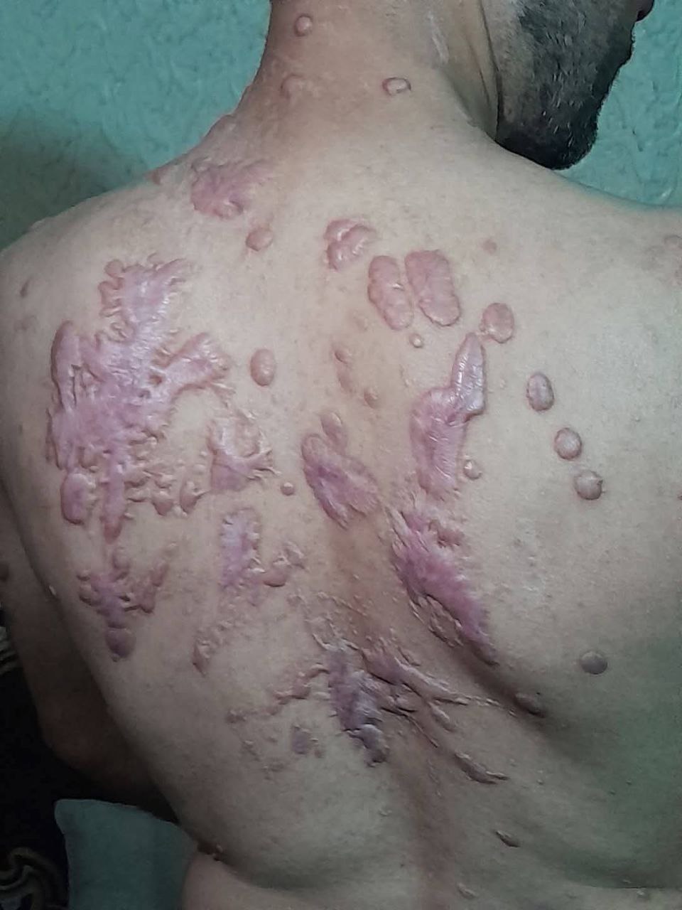Image in @xIsraelExposedx's post: Palestinian hostages Mohammed Abu Tawila was released and enduring extreme torture in Israeli priso…