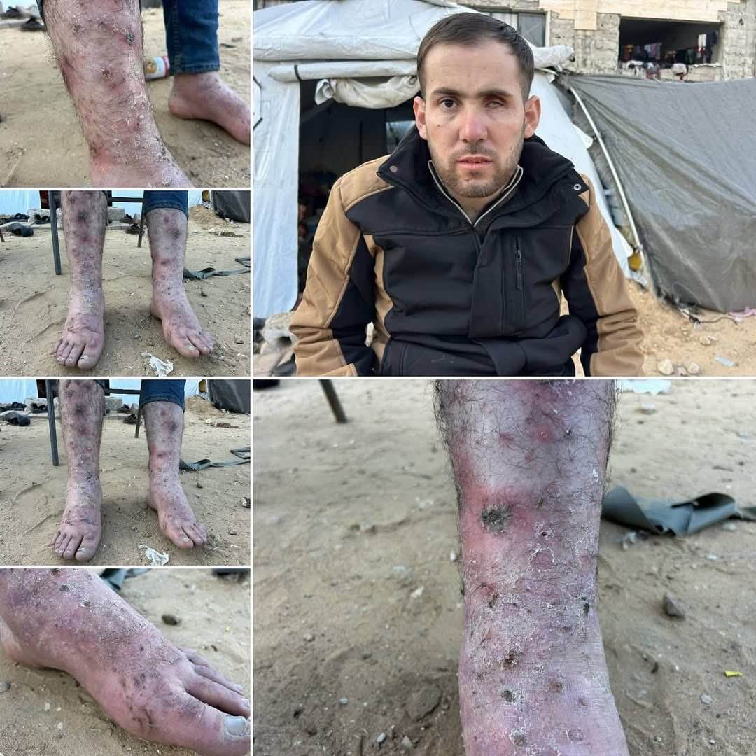 Image in @xIsraelExposedx's post: 🧵 All the Palestinian released hostages show signs of torture and abuse. They are missing arms, leg…