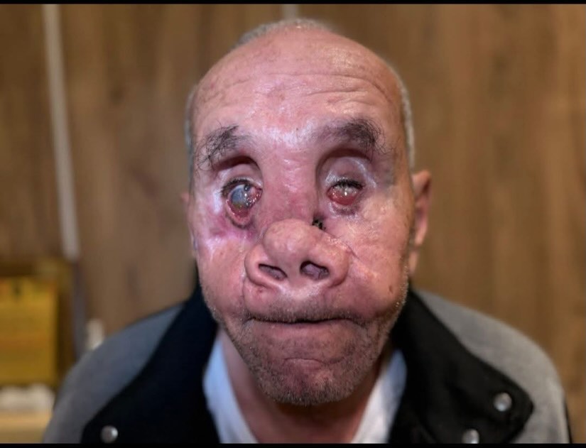 Image in @xIsraelExposedx's post: An Egyptian ophthalmologist shared these images of a man from Gaza who was recently evacuated after…