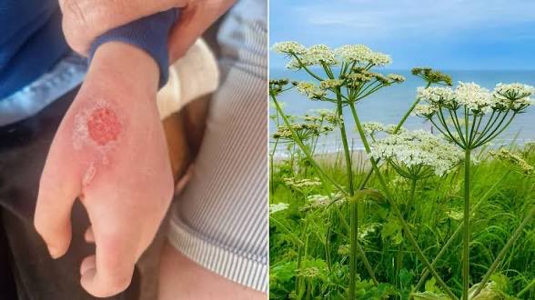 Image in @yesknow's reply: @MarioNawfal Giant hogweed is a menace on UK riverbanks too. The sap can burn your skin in sunlight…